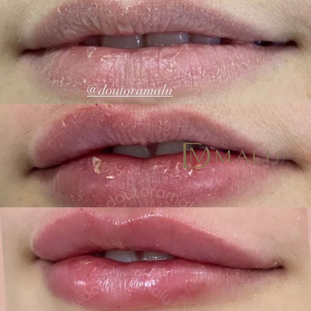 Dra. Malu Macedo Revitalização Labial #2.E
