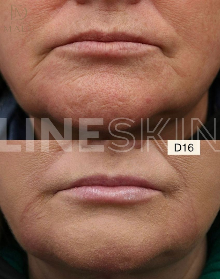 Line Skin - Malu 2